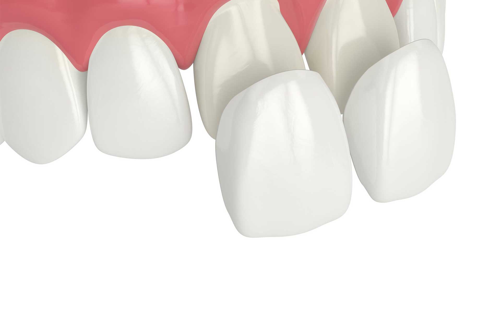 Faccette Sui Denti Faccette Sui Denti