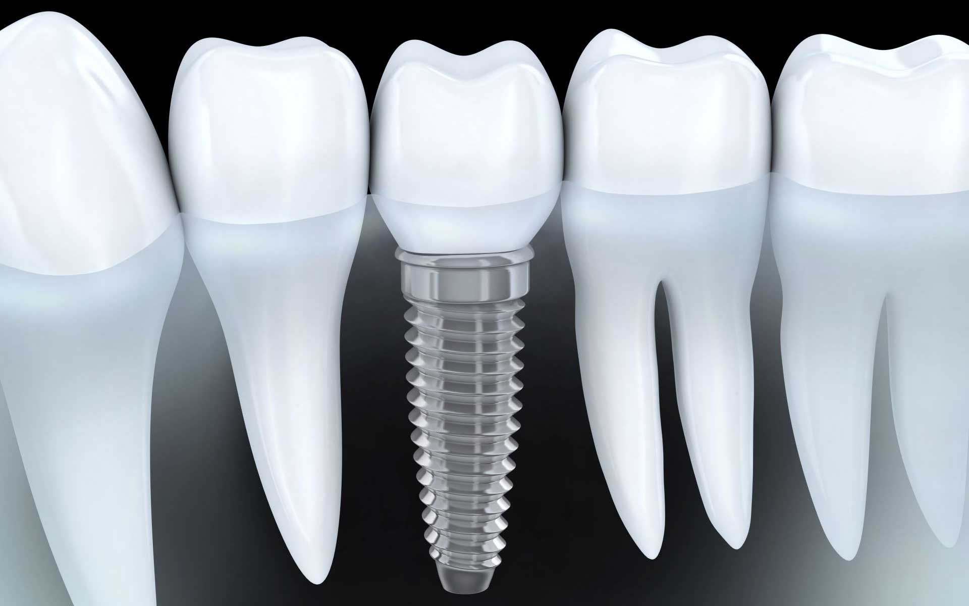 https://www.dentista-firenze.com/wp-content/uploads/2022/03/implantologia2.jpg