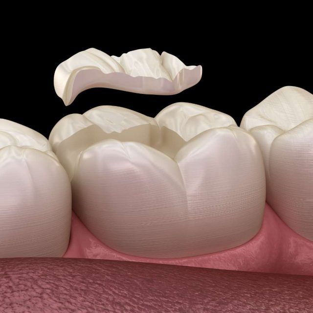 Dentista A Firenze Esperto In Intarsi Dentali Dentista A Firenze Esperto In Intarsi Dentali