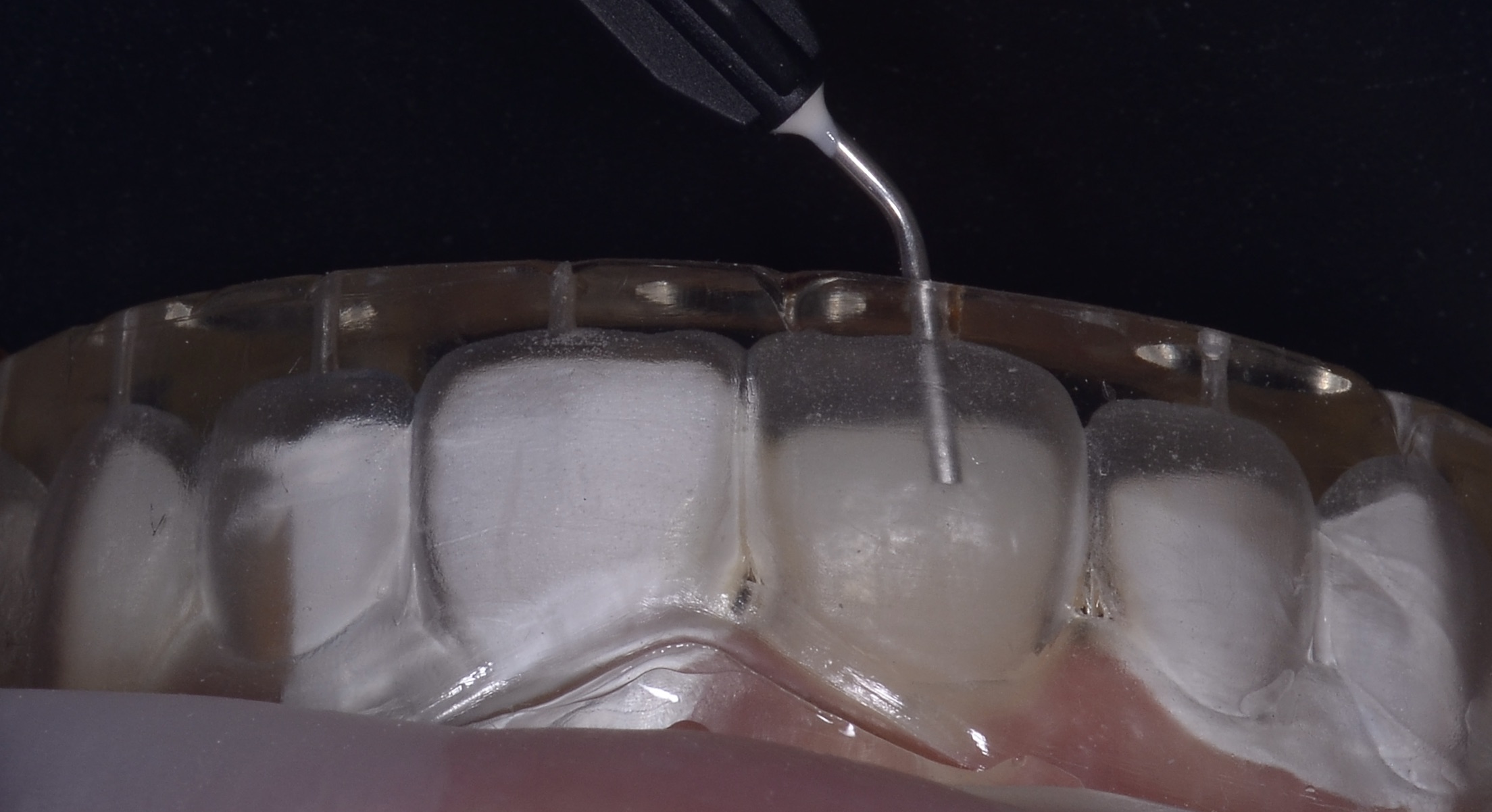 Faccette Dentali Cosa Sono Faccette Dentali Cosa Sono