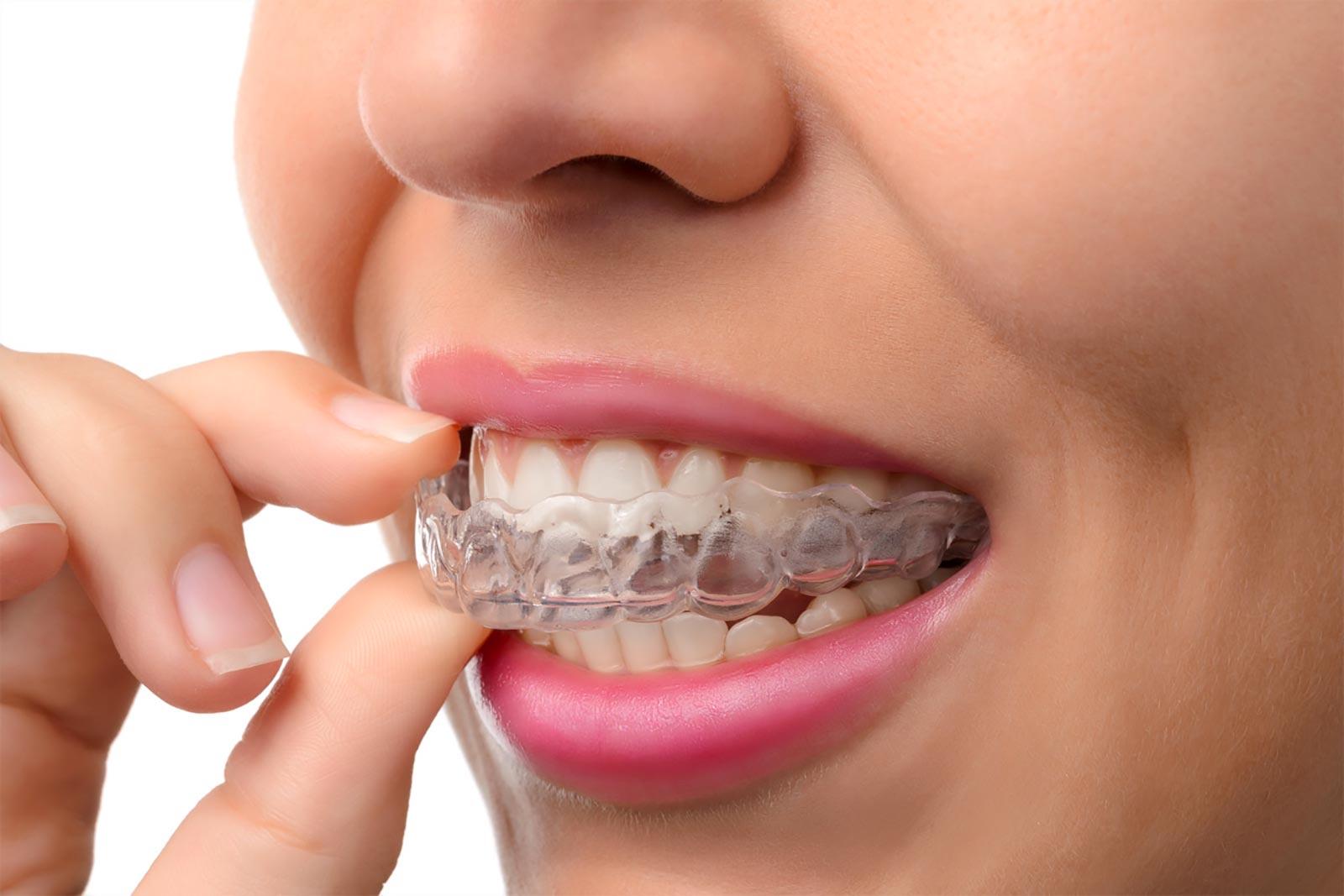 Allinetarori trasparenti apparecchi invisibili per denti a Firenze (2) Primo piano di una persona che sorride mentre posiziona con la mano un allineatore ortodontico trasparente sui denti superiori.